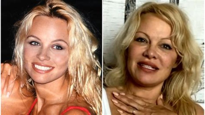 Pamela Anderson Plastic Surgery Before and After
